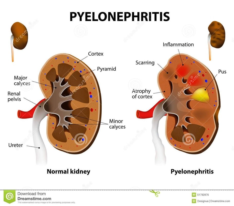 Cystitis and Pyelonephritis