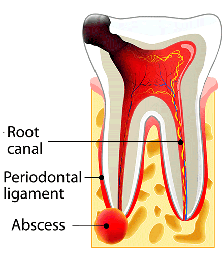 Dealing with an Abscessed Tooth?