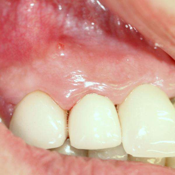 Dental Abscess Tooth Abscess Pictures Facial Swelling