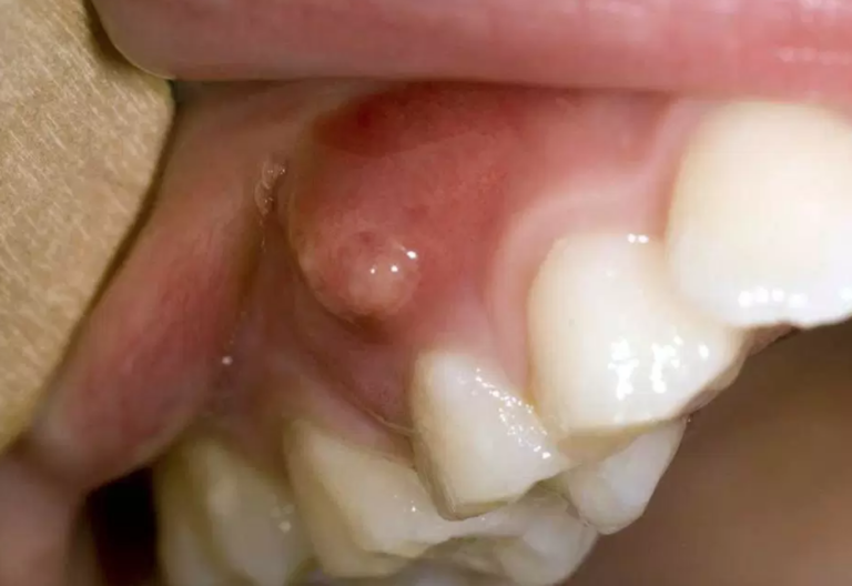Dental Abscess:Causes, Symptoms &  Treatments