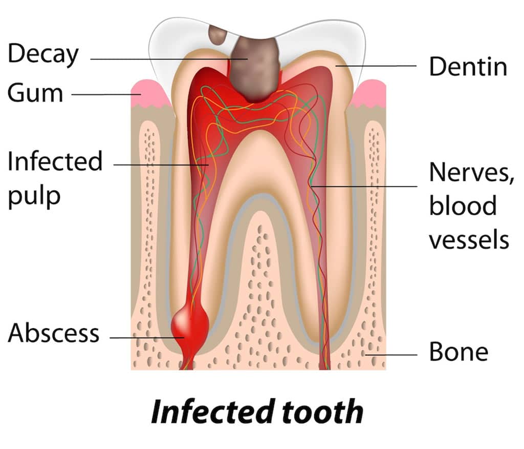 Dental Caries (Cavities) Comprehensive Review