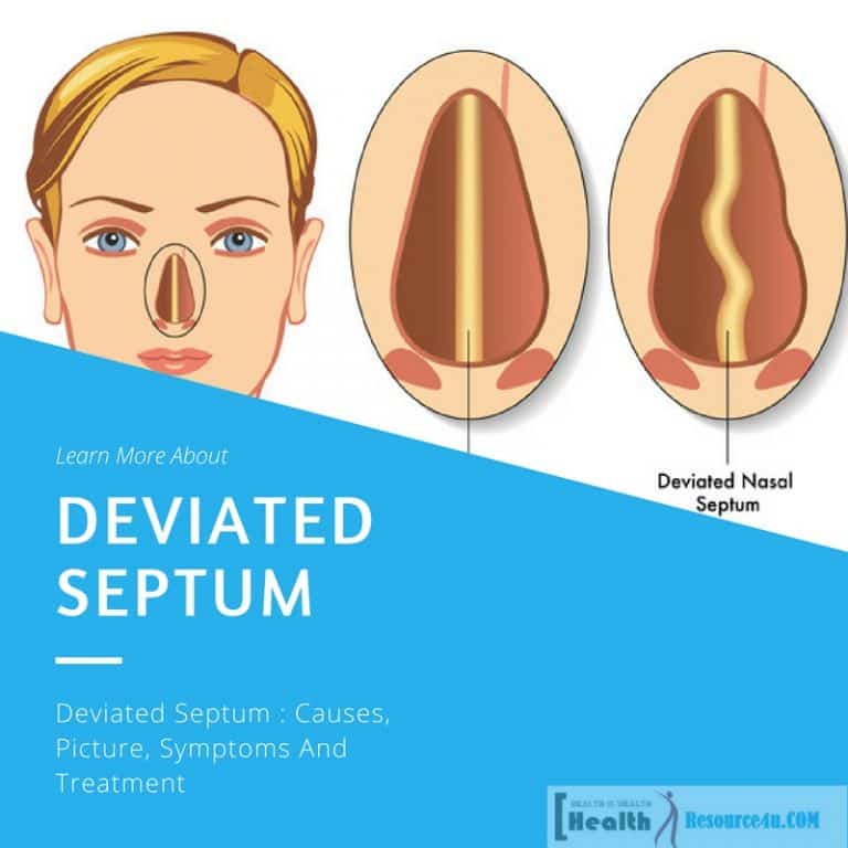 Deviated Septum : Causes, Picture, Symptoms And Treatment