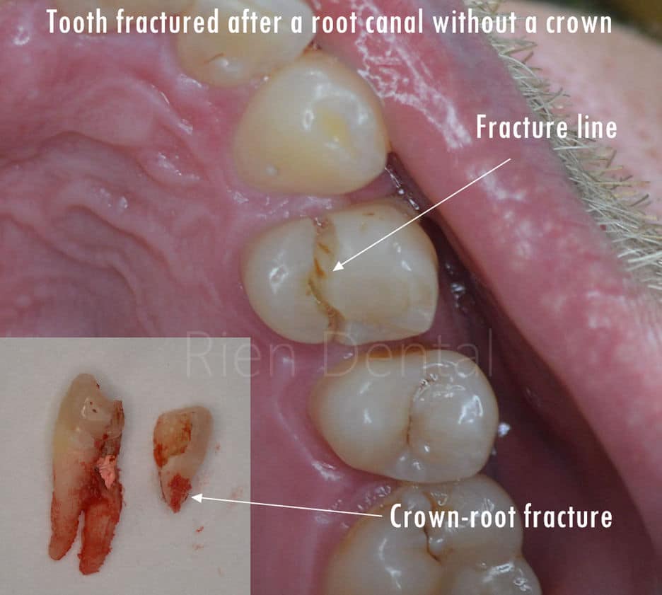 Do I really need a crown after a root canal?