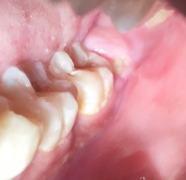 Do you have to get your wisdom tooth removed unless it hurts?