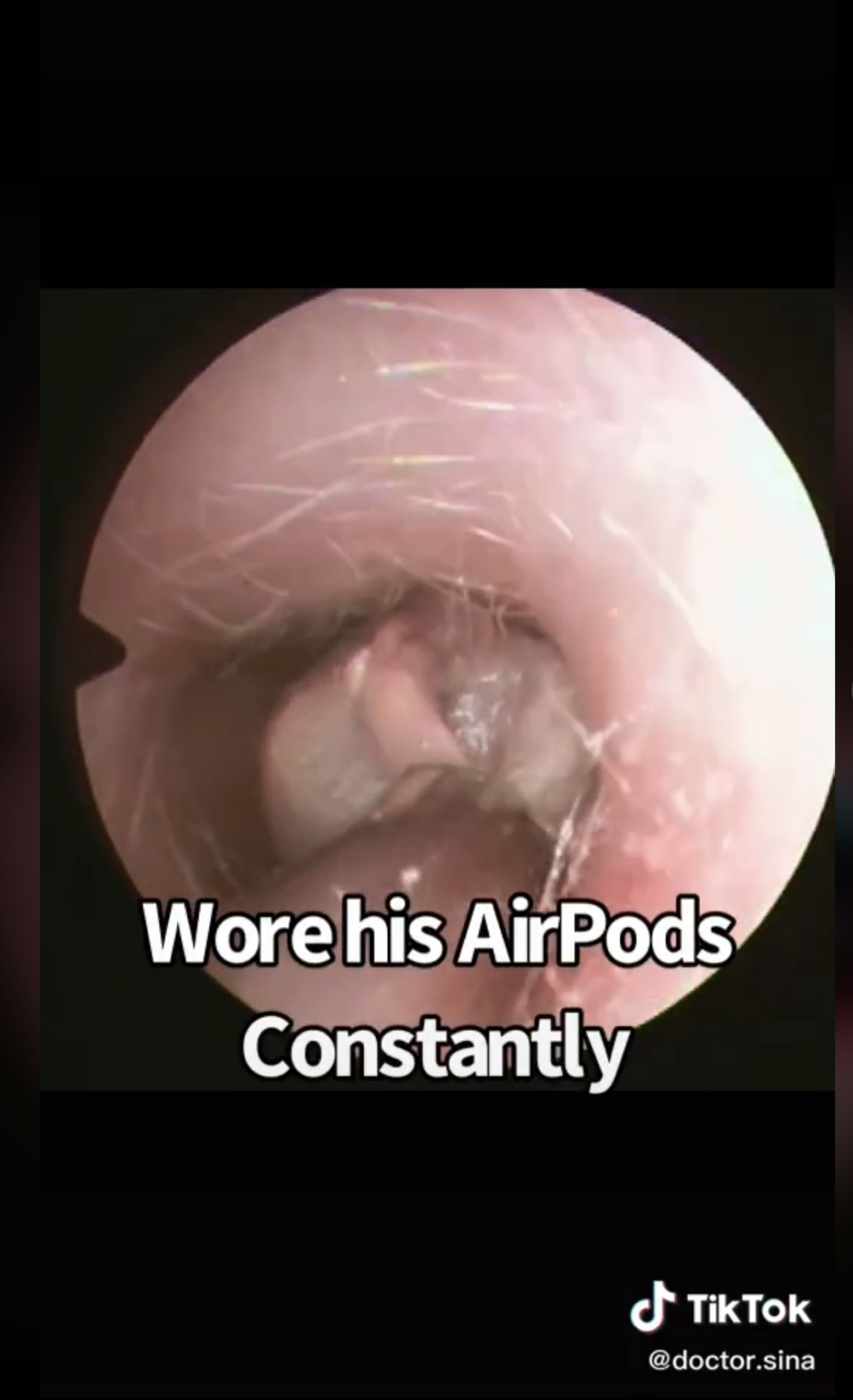 Doctorâs TikTok Showing Ear Fungus From âConstantâ? AirPod Use Is Going ...