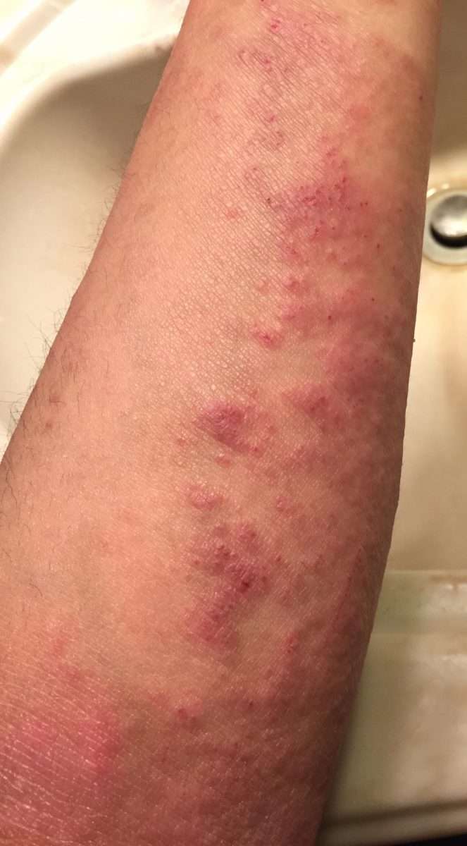 Does anyone have eczema that looks like this? I canât tell if this is ...