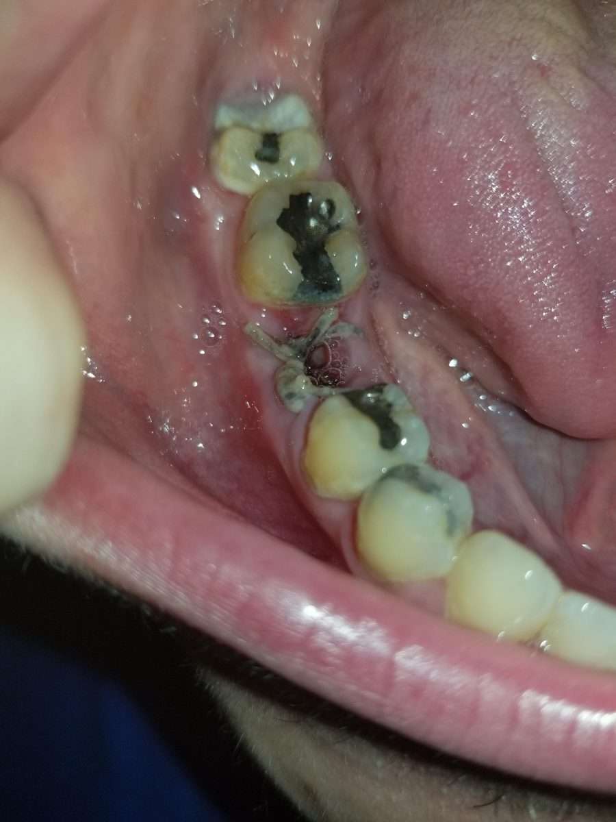 Does it look like my tooth extraction site is infected or too deep ...