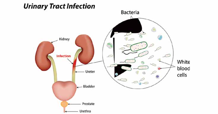 Does Urinary Tract Infection Affect Women