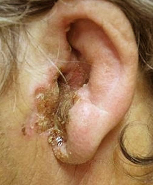 Ear Canal Infection