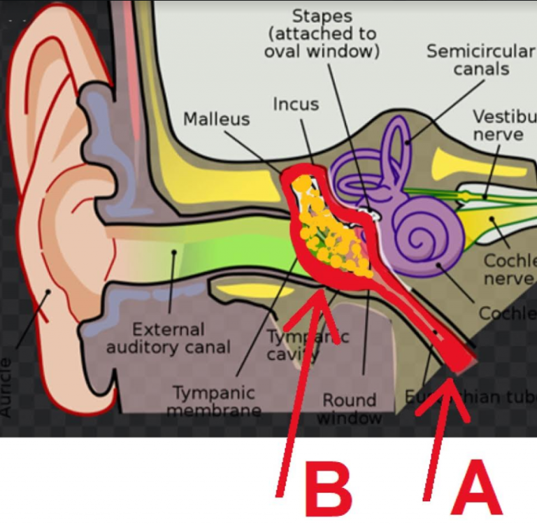 Ear Pain and Ear Infections Symptoms and Treatment