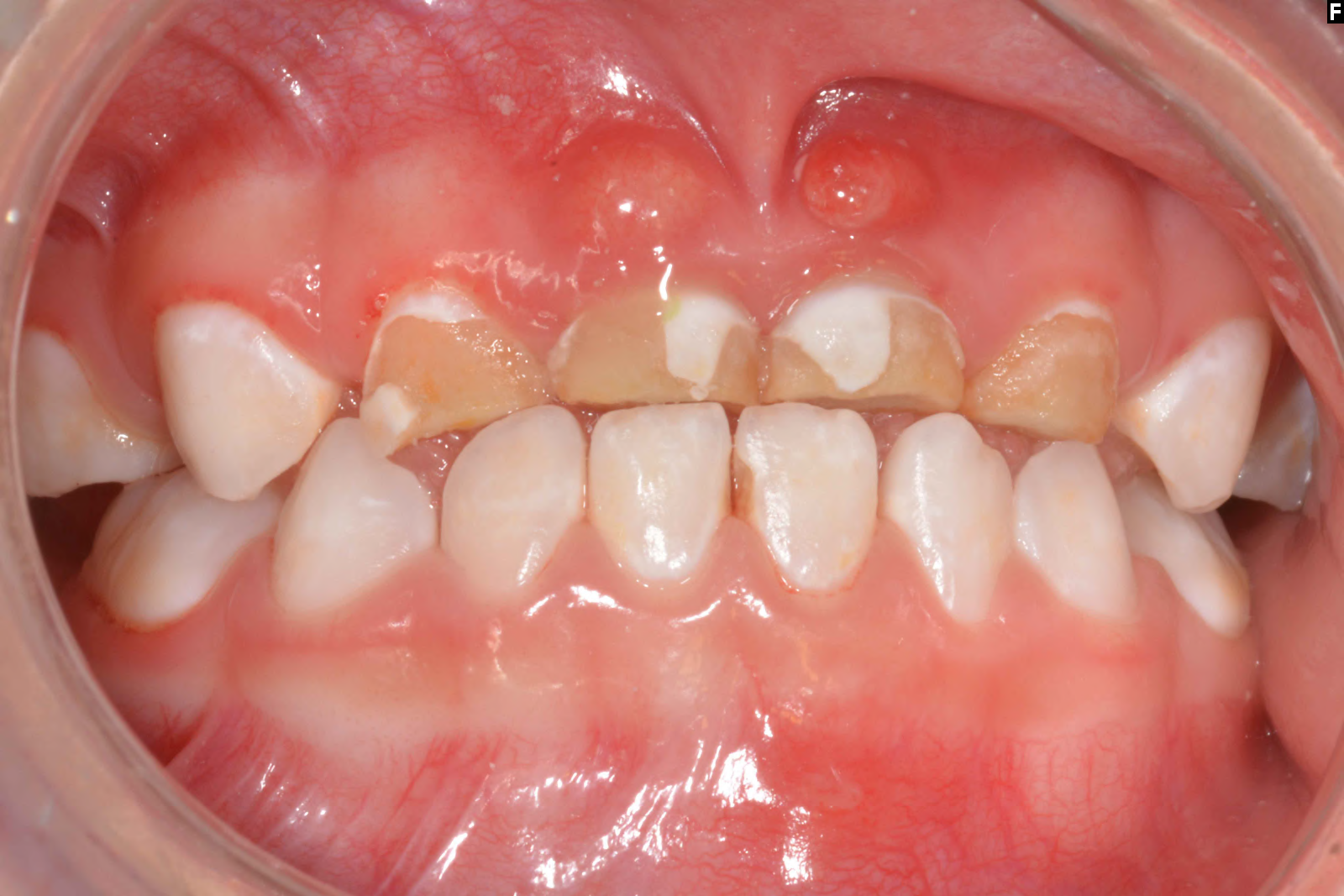 Early Childhood Caries Symptoms: White Spot Lesions, Tooth Decay, Pain ...