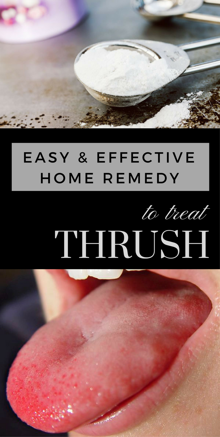 Easy &  Effective Home Remedy to Treat Thrush (With images ...