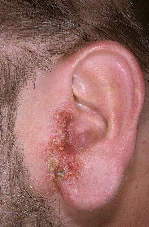 Eczema on the Ears Pictures  11 Photos &  Images ...