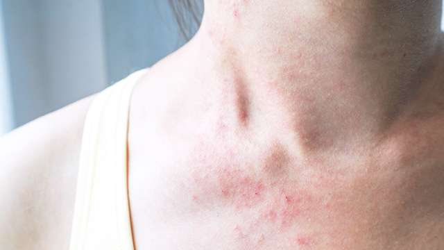 Eczema Vs. Fungal Skin Infection: Causes, Differences, Treatment