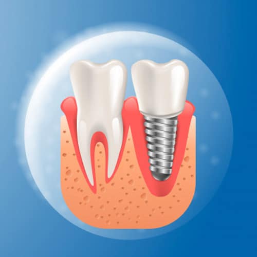 Emergency Dental Implant Treatment » LDN Dental (500+ 5