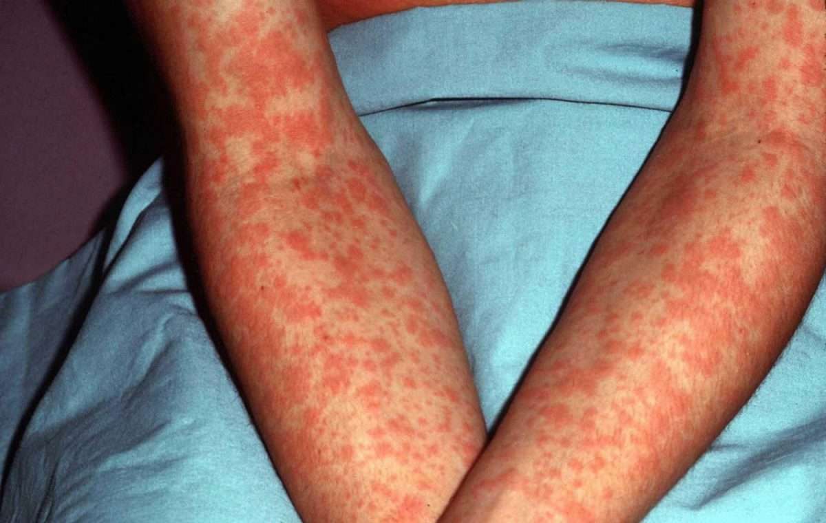 Epstein Barr virus infection causes, symptoms, cancer, diagnosis ...