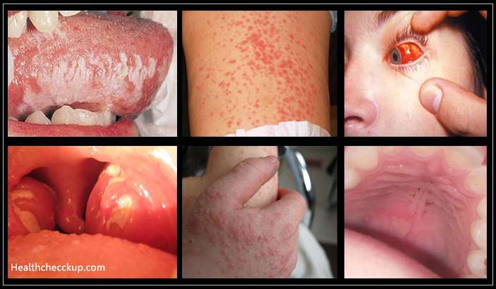 Epstein Varr Virus Rash: Definition, Symptoms, Causes, Treatment, Pictures
