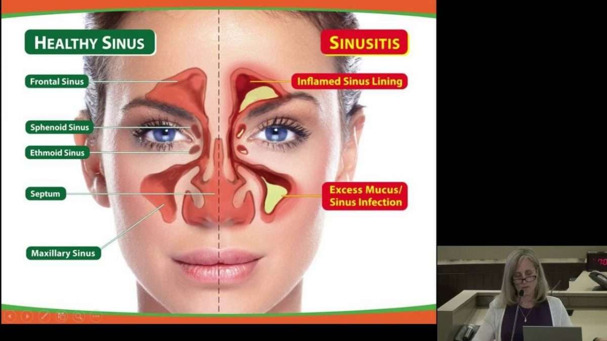 Evaluation and Management of Acute and Chronic Sinusitis