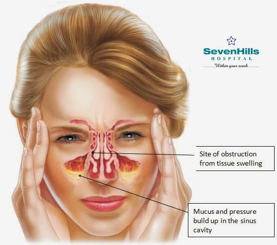 EVERYTHING ABOUT SINUSITIS YOU WANTED TO KNOW!