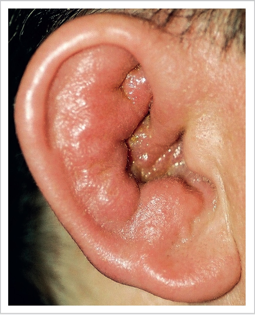 External Ear Disease