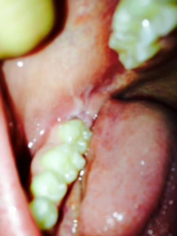 Extreme gum/jaw pain near back molars