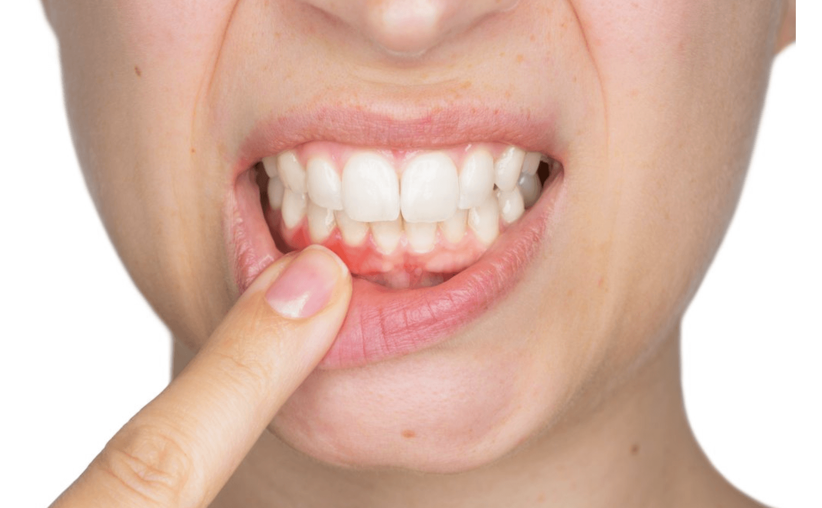 FAQ: " My Gums Are Swollen Above a Tooth â Do I Have an Abscess?"
