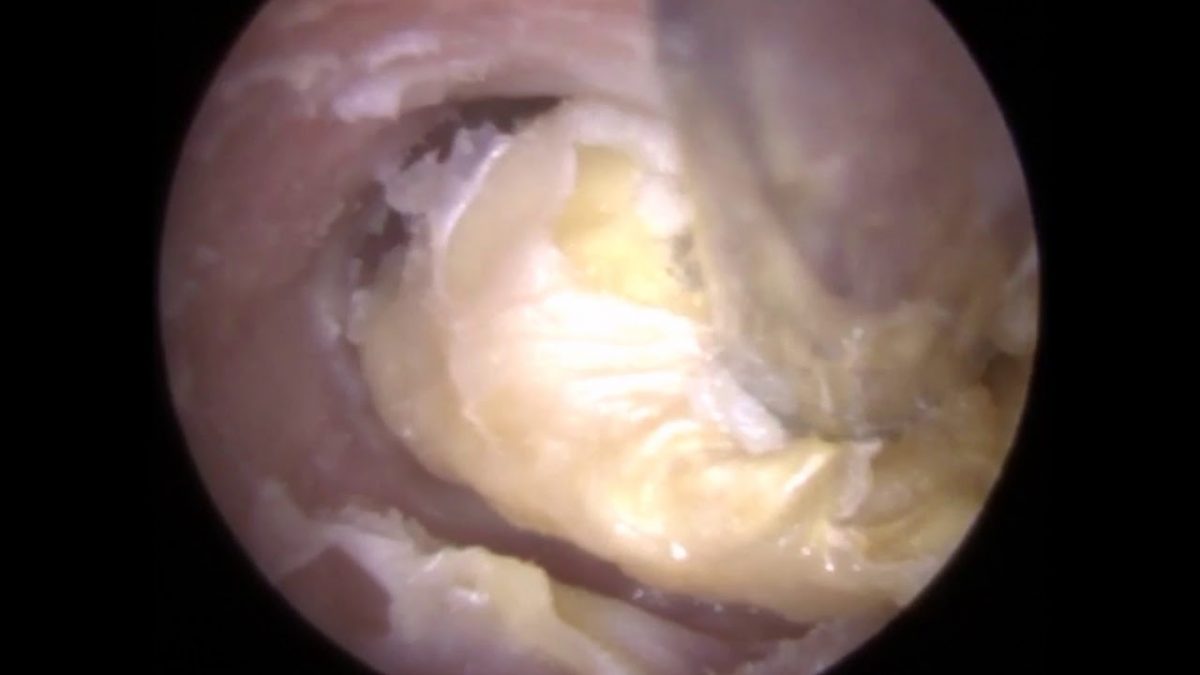 FUNGAL Ear Wax Removal (Otomycosis) in Otitis Externa Ear Canal