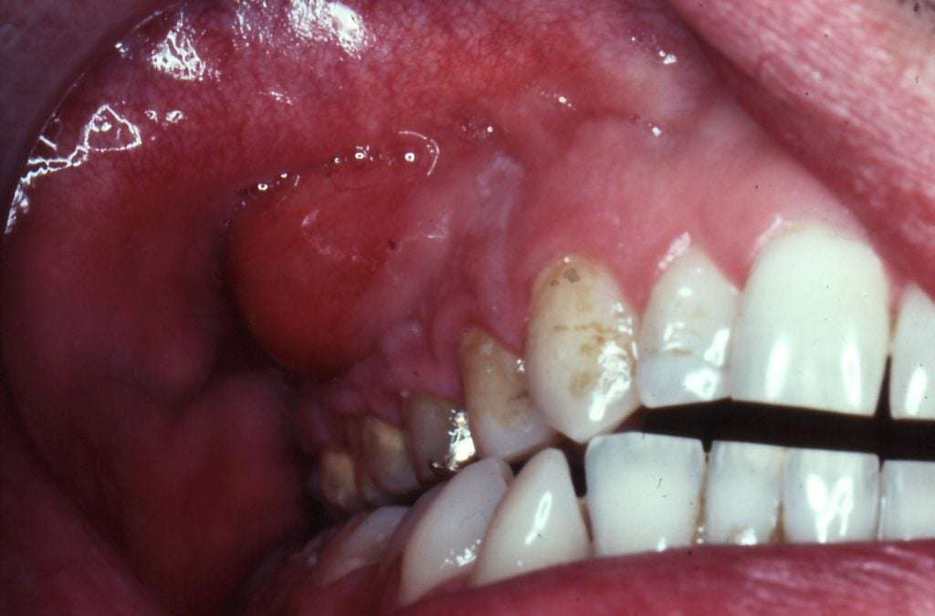 Gallery  Dental Abscess/Cellulitis/Ludwigs Angina