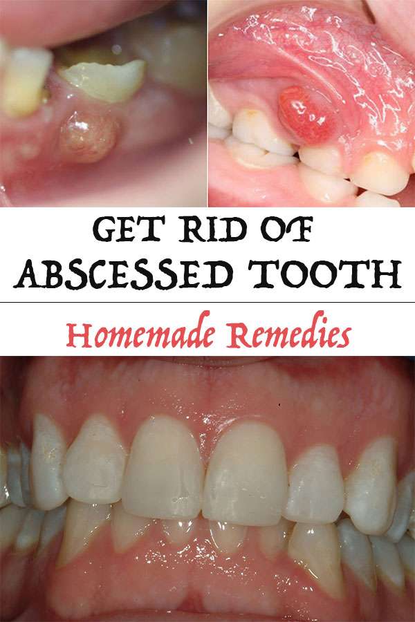 Get Rid of Abscessed Tooth