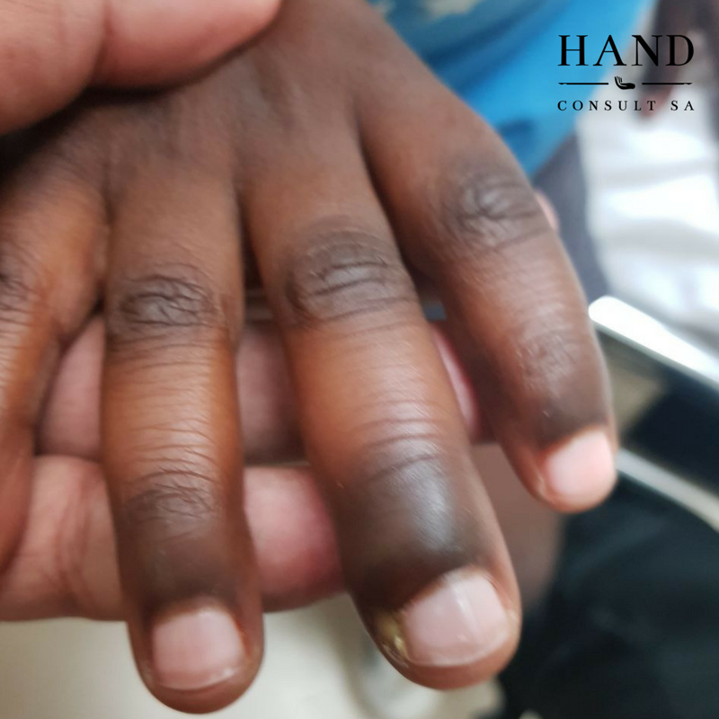 Hand injuries in children