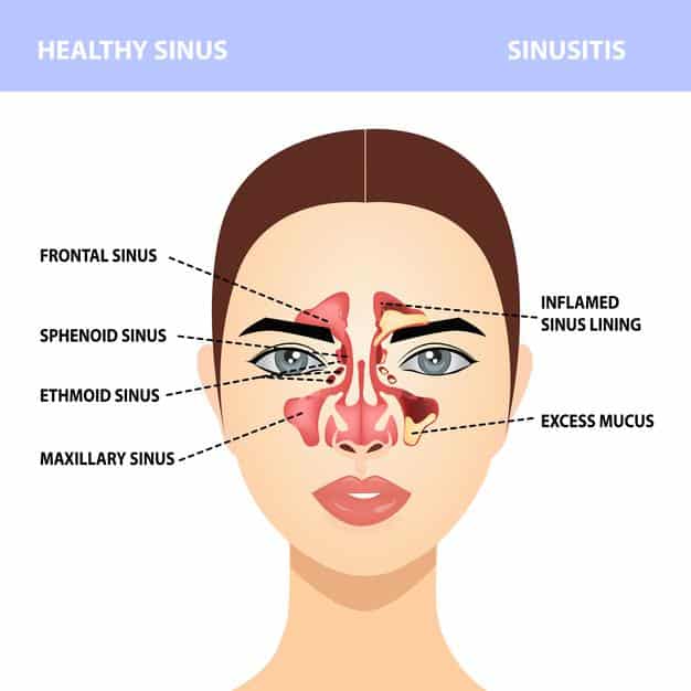 Hard bumps on roof of mouth sinus infection â All your info about ...