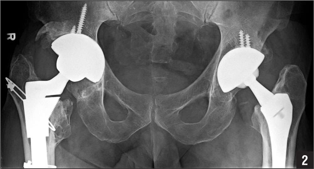 Hematogenous Infection of Total Hip Arthroplasty With ...