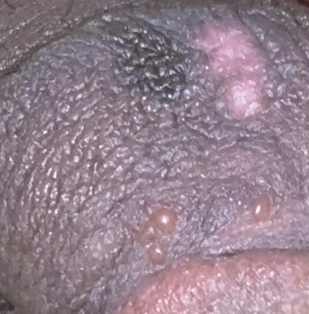 Herpes? Or Topical fungal infection.