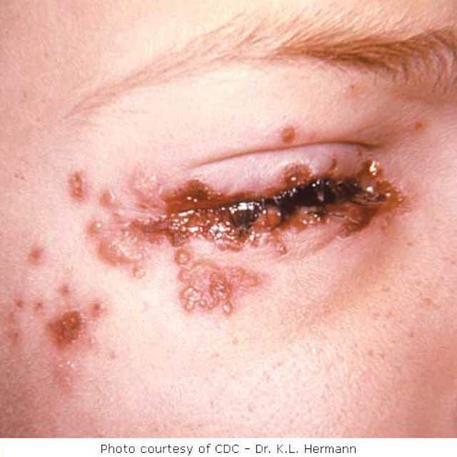 Herpes Pictures and Cold Sores Pictures