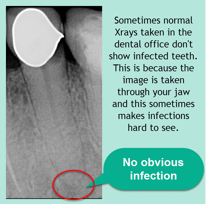 Hidden Root Canal Infections and How to Find Them