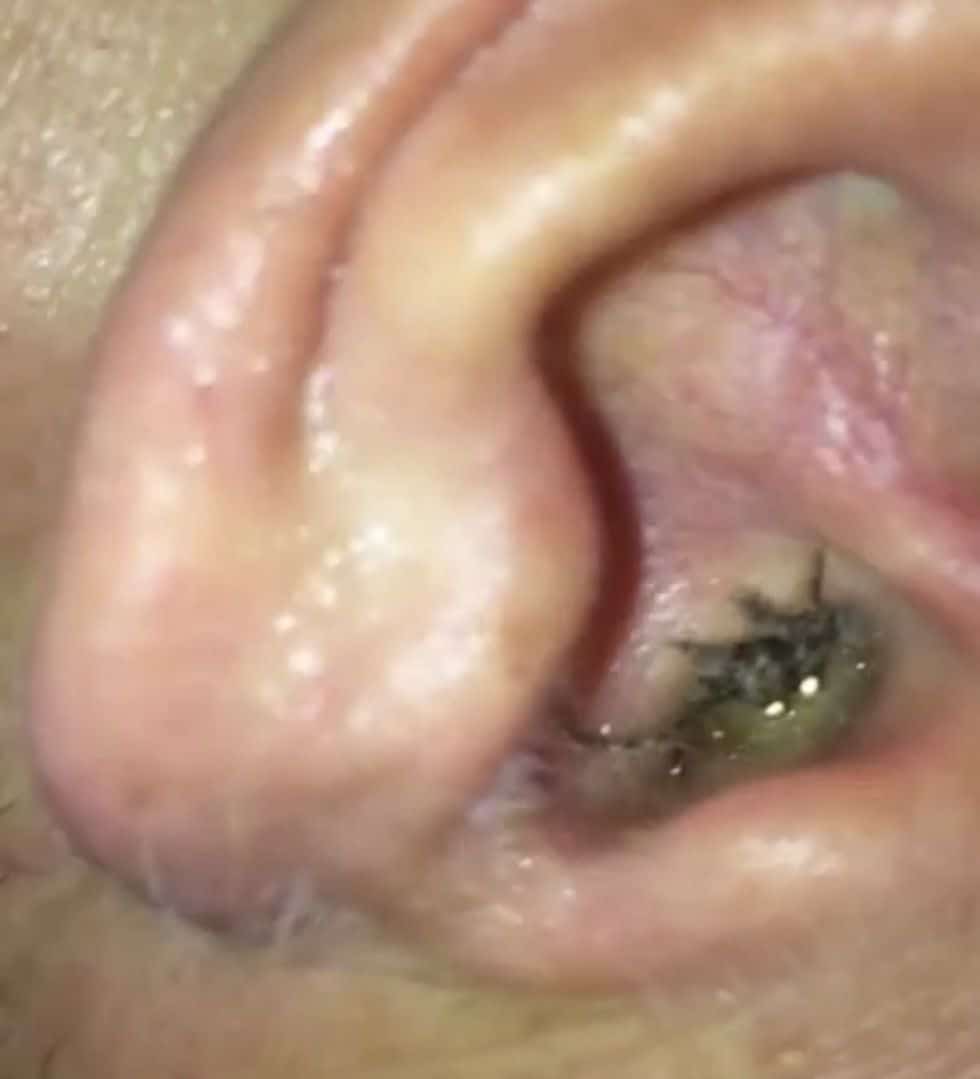 Hit With a Painful Ear Infection, He Takes a Closeup Peek With His ...