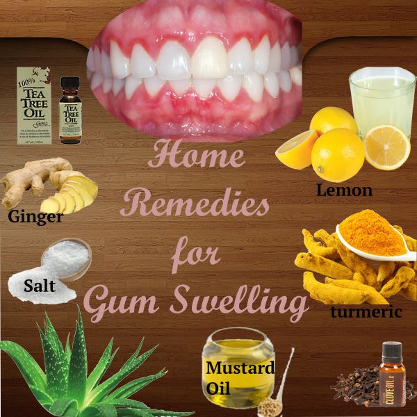 Home Remedies for Gum Swelling:Top 10 Natural Remedies for Gingivities ...