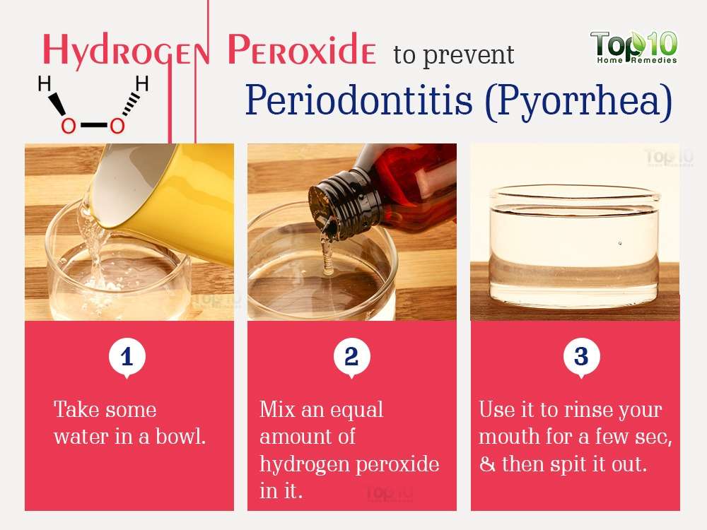 Home Remedies for Periodontitis (Pyorrhea)