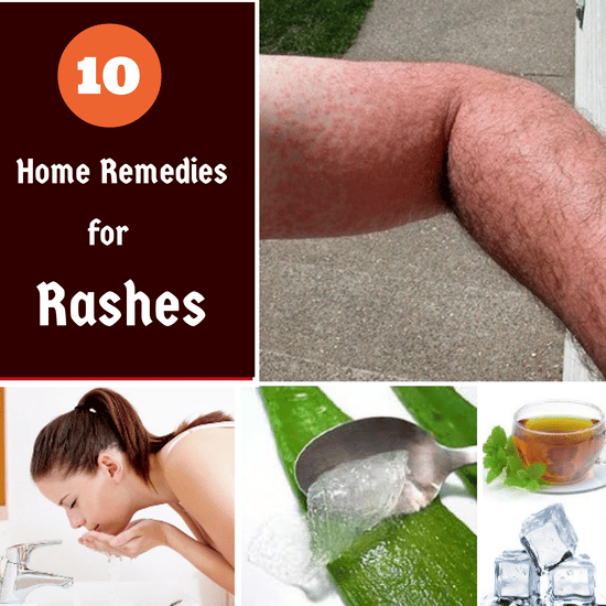 Home Remedies For Rashes