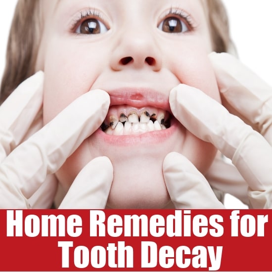 Home Remedies for Tooth Decay