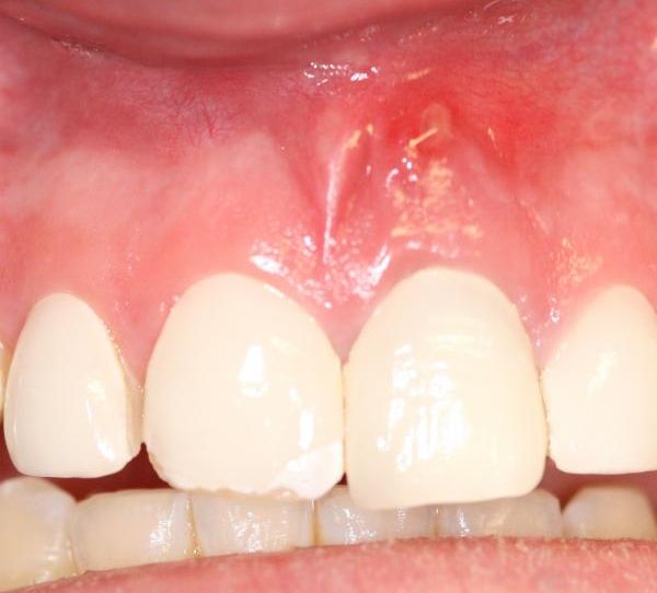 Home Remedies for Treating Gum and Tooth Abscess Effectively