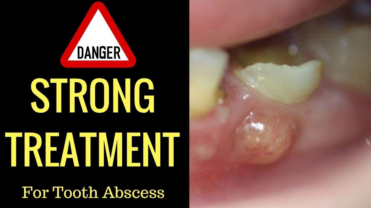 Homemade Antibiotics For Abscess Tooth
