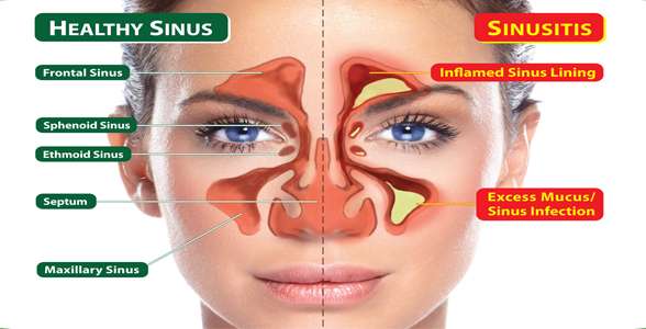 Homeopathy For Sinus Infection