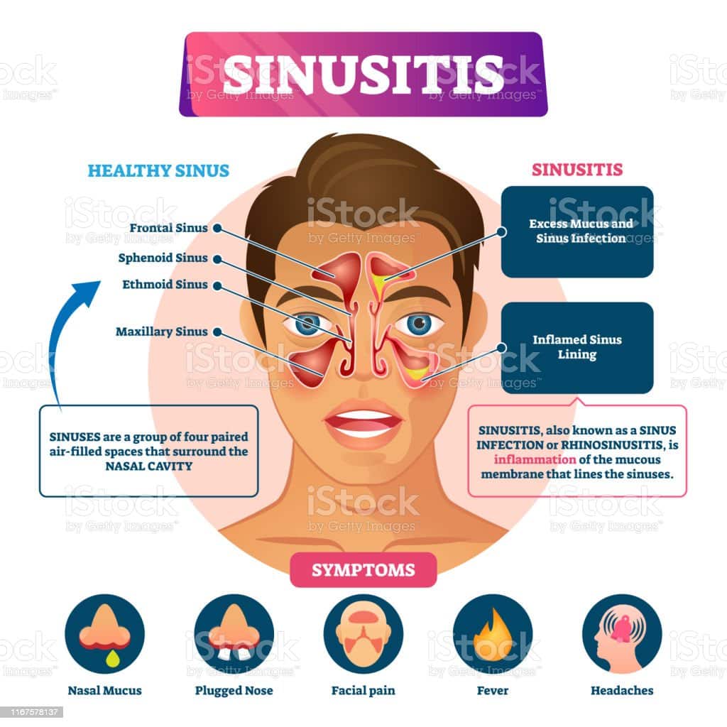 How Do You Get A Bacterial Sinus Infection