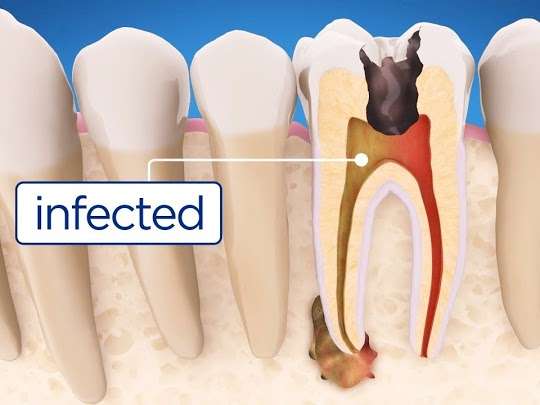 How Do You Know if Your Root Canal is Infected?