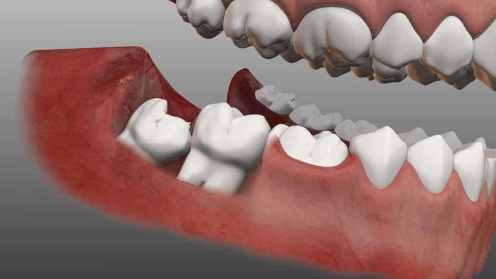 How does #WisdomTooth Removal Affect #OrthodonticCare ...