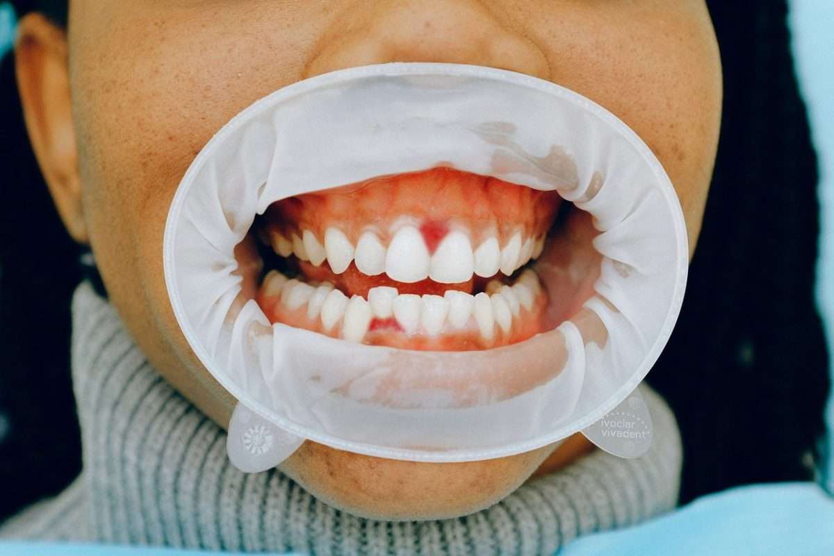 How Long Does It Take for a Tooth Infection to Spread?