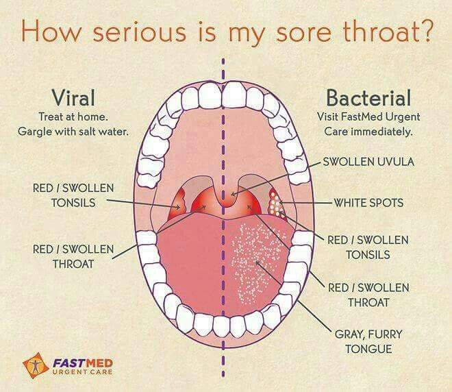 How serious is my sore throat?