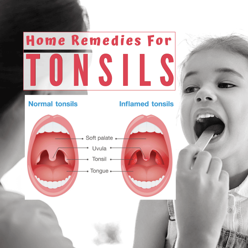 How To Cure Tonsil Infection