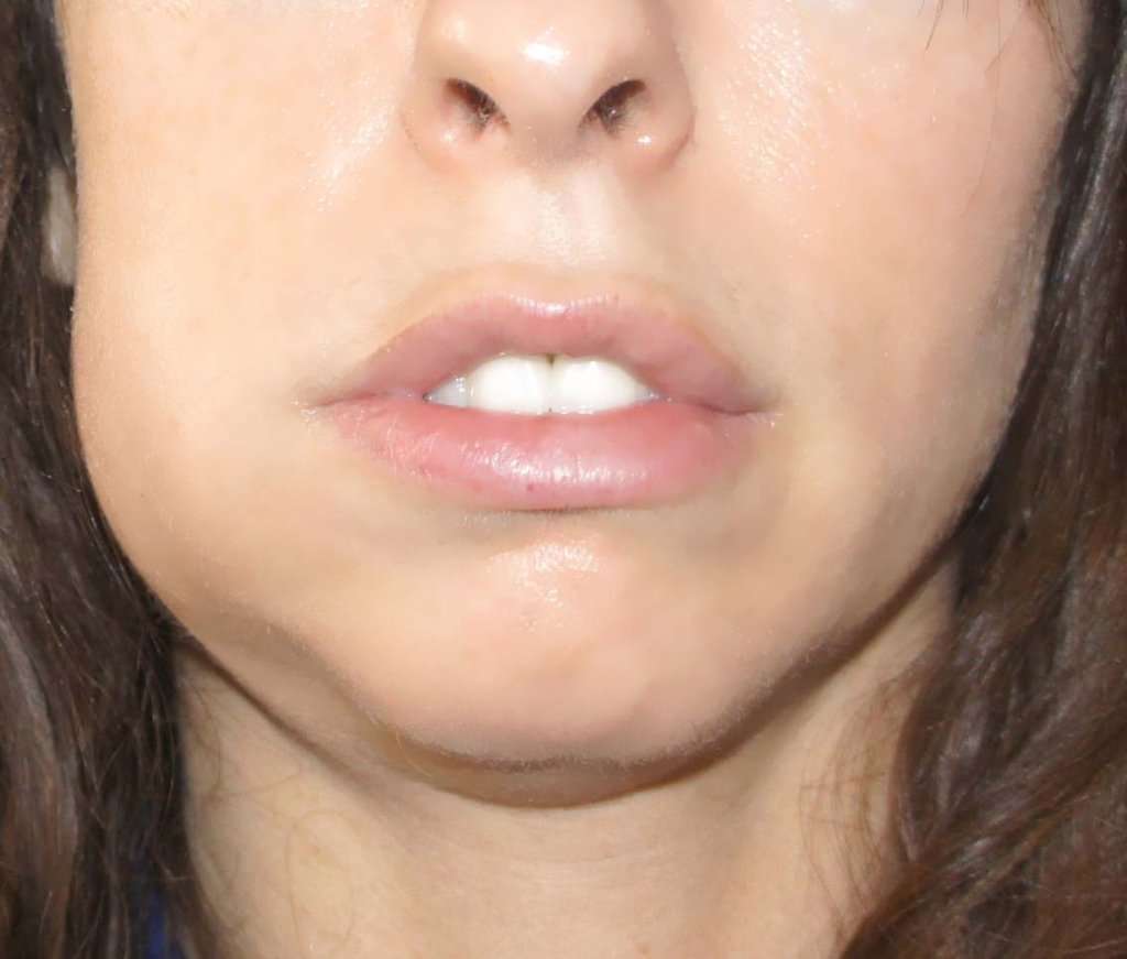 How to Deal with Swollen Face from Tooth Infection